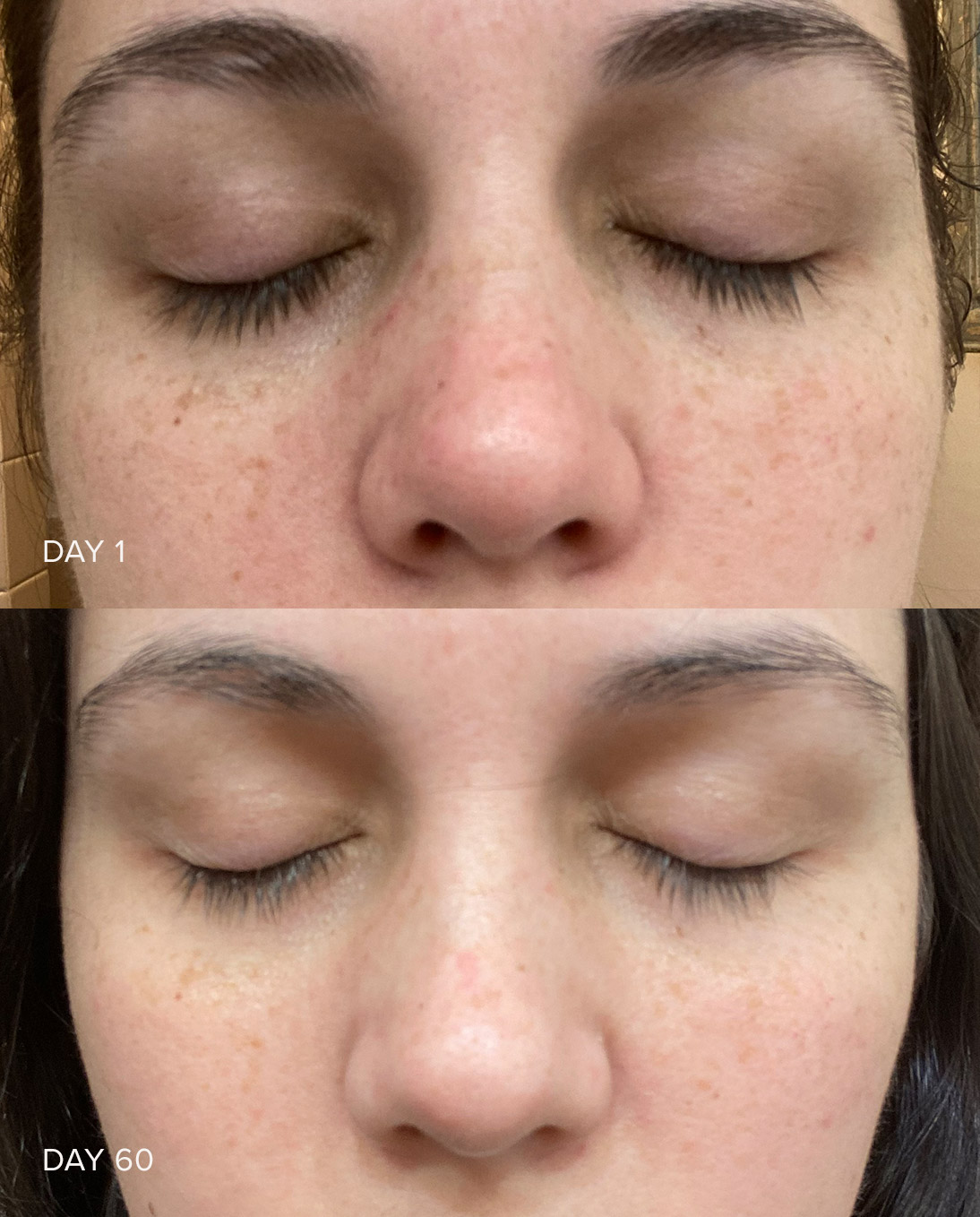 Vitamin C Serum Before And After Partyjuja